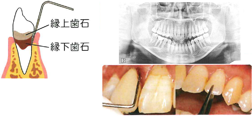 お口のクリーニング 歯石除去等 公式 デンタルクリニック夏帆