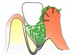 歯周病5