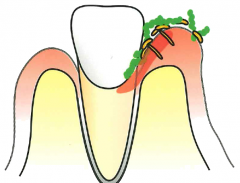 歯周病2